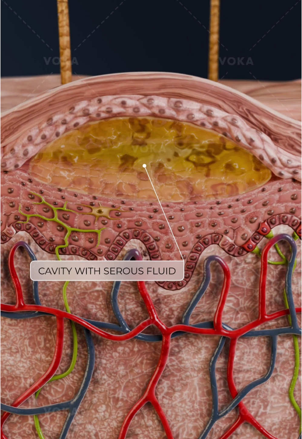 What do vesicles on the skin tell us about underlying conditions? Dermatology in 3D - VOKA  Vesicles are small, fluid-filled blisters less than 5 mm in size that form when fluid collects just beneath the epidermis. These tiny sacs can appear due to various causes — from mild allergic reactions and irritants to infections and autoimmune diseases.   Common causes of vesicles include: 🔹 Contact dermatitis, triggered by allergens or irritants 🔹 Viral infections like herpes or chickenpox 🔹 Bacterial infections such as impetigo 🔹 Insect bites or stings 🔹 Autoimmune blistering disorders like bullous pemphigoid   Vesicles often cause itching, tenderness, or mild pain and may cluster into a vesicular rash that can spread quickly, especially in infectious cases.   Recognizing vesicles’ appearance, location, and accompanying symptoms is crucial for accurate diagnosis and appropriate treatment — ranging from topical creams and antihistamines to antiviral or immunosuppressive therapies.   📌 Visualize vesicles and many other dermatological conditions in 3D with VOKA 3D Anatomy & Pathology!   #vesicles #dermatology #skinhealth #dermatology #3danatomy #medstudents #medicaleducation #anatomy #pathology #3danatomy #digitallearning #humanbody 