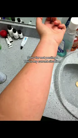 I apologize for not posting, this is my current situation. I’ve had the hives for 3 days.  Idk what’s causing it at this point.  #foryoupage 