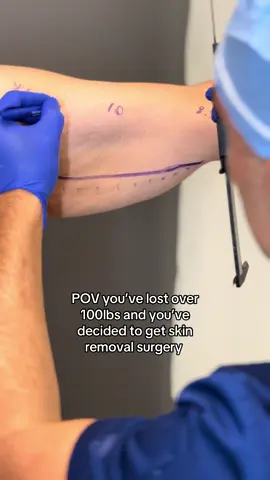 Brachioplasty incoming! #armlift #brachioplasty #miamisurgeon #miamisurgery #plasticsurgery 