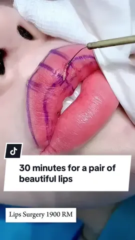 30 minutes for a pair of beautiful lips#cosmeticsurgery #fyp #lipsurgery #surgerytiktok #kualalumpur #malaysia #tiktokmalaysia #dryangkim 