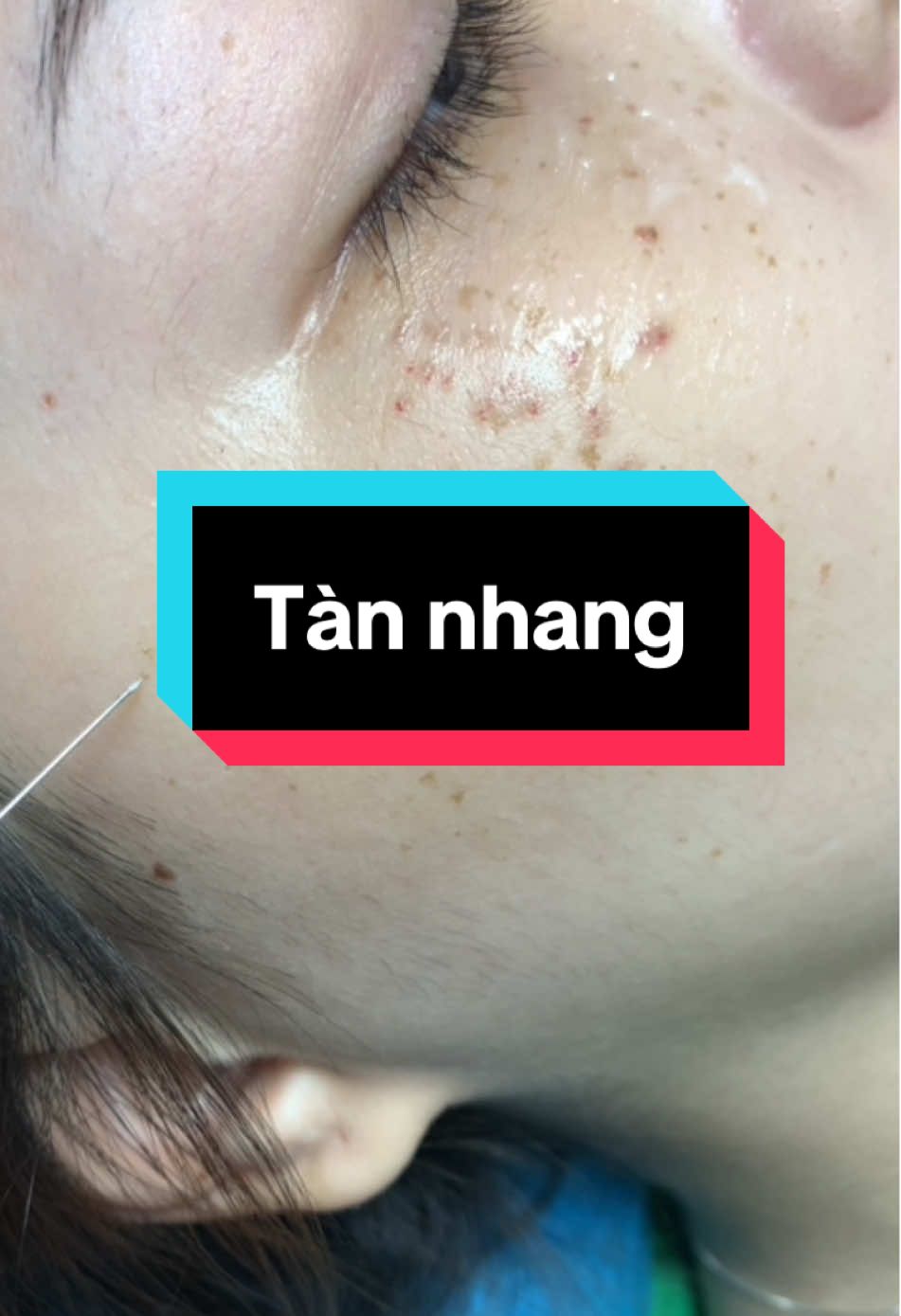 Plasma lạnh với tàng nhan