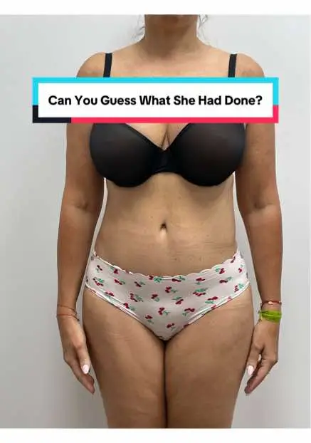 Results so natural, no one can tell she’s had work done 🤫👏 Our gorgeous patient had a full tummy tuck and later returned for additional liposuction and Renuvion to complete her transformation with Dr. Z. She’s 1.5 years post-op from her tummy tuck and just a few months out from her final contouring — and she’s looking absolutely stunning! #tummytuck #abdominoplasty #fulltummytuck #tummytucksurgery #vadoplasticsurgery #drz #plasticsurgery #plasticsurgeon 