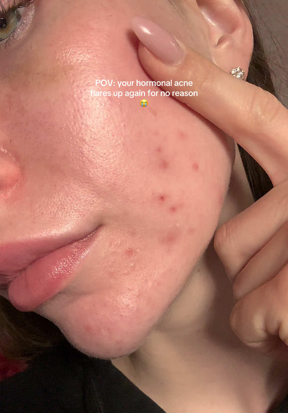 when you think it’s over but your acne says “hi again” 😭😭😭 #acneskin #acne #hormonalacne #cysticacne #comedones #pimples #acneproneskin 
