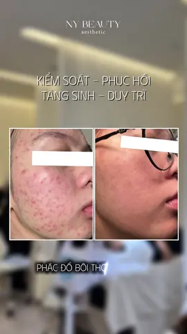 Hình ảnh khách tự tin hơn, đẹp hơn từng ngày là động lực của Ny trên hành trình đi.ều tr.ị da cùng khách iu ❤️ #nybeautyaesthetic #feedback 