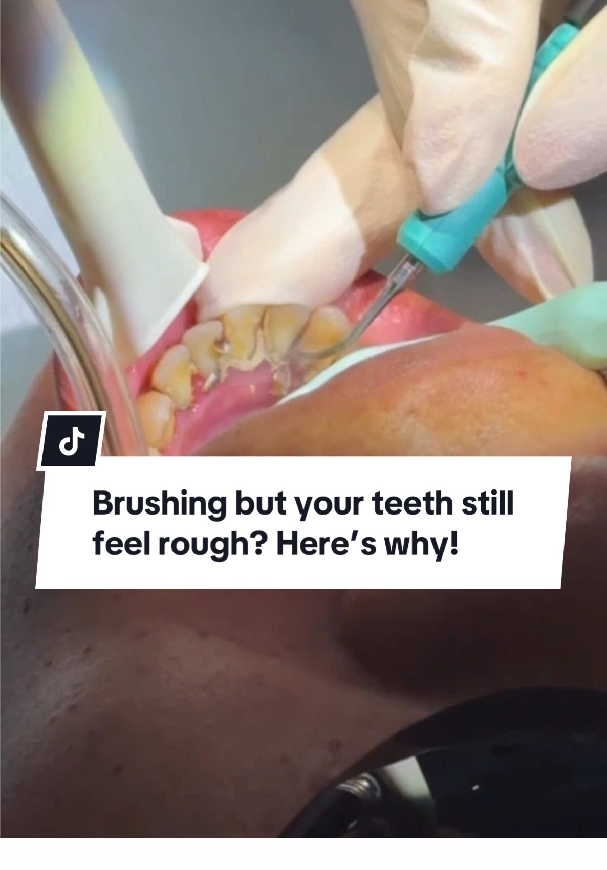 Teeth feeling rough even after brushing for ages? You’re not imagining it.   Make INNformed decisions about your dental health  📍 Book your oral health evaluation and professional tooth cleaning today 📞 Call/WhatsApp: (868) 472-8666 🔗 Link in bio | www.smileinntt.com 