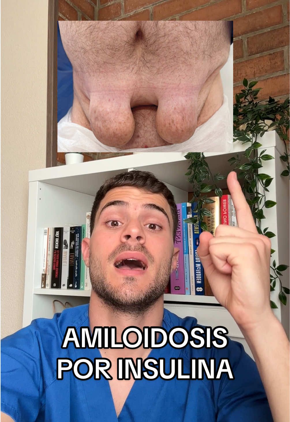 Hoy os comparto este raro caso clínico publicado recientemente en la revista The New England Journal of Medicine que nos sirve para recordar la importancia de ir rotando los sitios de inyección de insulina para evitar complicaciones como la amiloidosis cutánea o la lipohipertrofia.