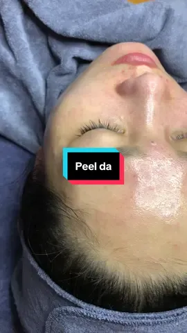 Da mụn ẩn peel là chân ái nha🥰#spa #xuhuong #duocmypham #chamsocda 