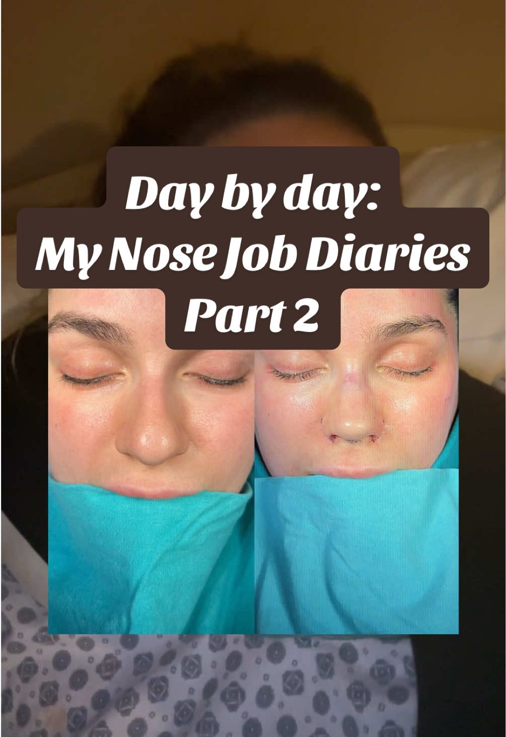 The first night hospital stay after getting a nose job is as comfortable as you might think! My best recommendation is to make sure you have a good neck pillow and some throat lozenges because the dry mouth is pretty crazy! 🫶🏼✨👏🏼 #nosejob #nosejobcheck #nosejobturkey #rhinoplasty #turkeyrhinoplasty #nosejobdiary #turkeynosejob #denizdilek #nosejobhealing #rhinoplastyhealing 