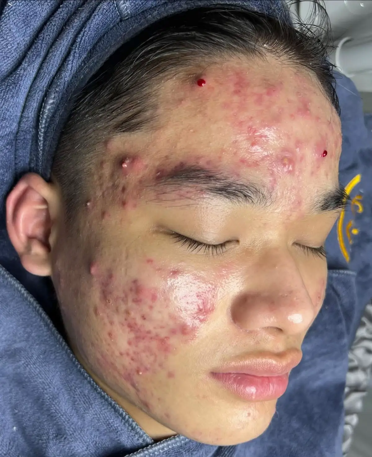 Mình luôn tin rằng: một làn da khỏe không chỉ đẹp, mà còn giúp bạn tự tin hơn mỗi ngày. Nếu bạn đang lo lắng vì mụn ẩn, mụn viêm hay da xin màu, hãy để tụi mình chăm sóc cho bạn bằng liệu trình: *   Nặn mụn chuẩn y khoa - nhẹ nhàng, an toàn, không đau rát *   Tư vấn phác đồ điều trị cá nhân hóa theo từng loại da *   Lên routine chăm da tại nhà với mỹ phẩm chất lượng, an toàn Nhắn tin ngay cho em để được tư vấn miễn phí và đặt lịch nhé!#Vuatrimun #chamsocdakhoahoc #spathudaumot #lamdep #xuhuong 