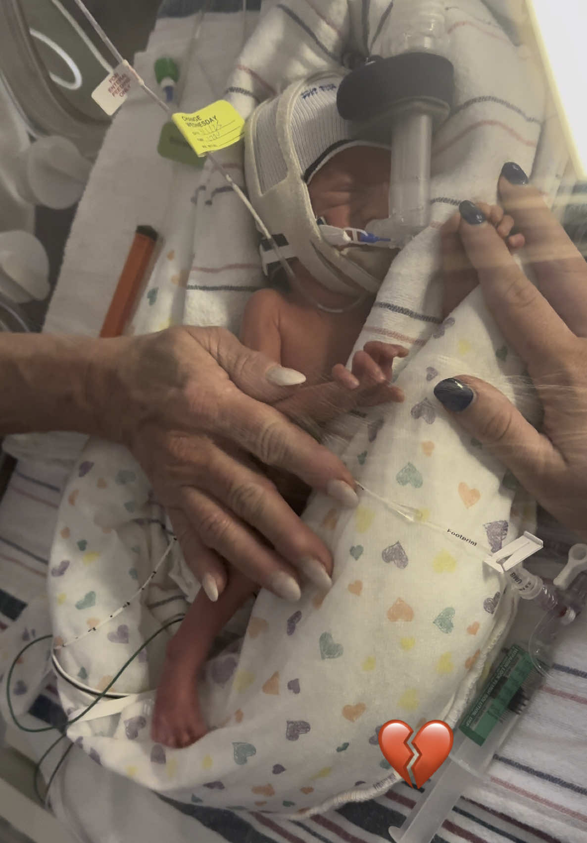 💔💔 I’m so sorry son @Connor Jensen  #preemie #nicubaby #nicumom #nicustrong #kcnt1 #kcnt1awareness #30weeksold #nicujourney #preemiestrong #nicubabies #dayinthelife #polyhydramnios #griefjourney #grief #heartache #heartbroken #babyboy #newbornbaby #csectiondelivery #emergencycsection 