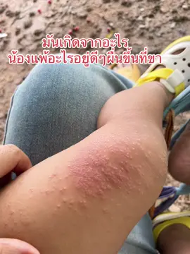 #ผื่นที่ขา