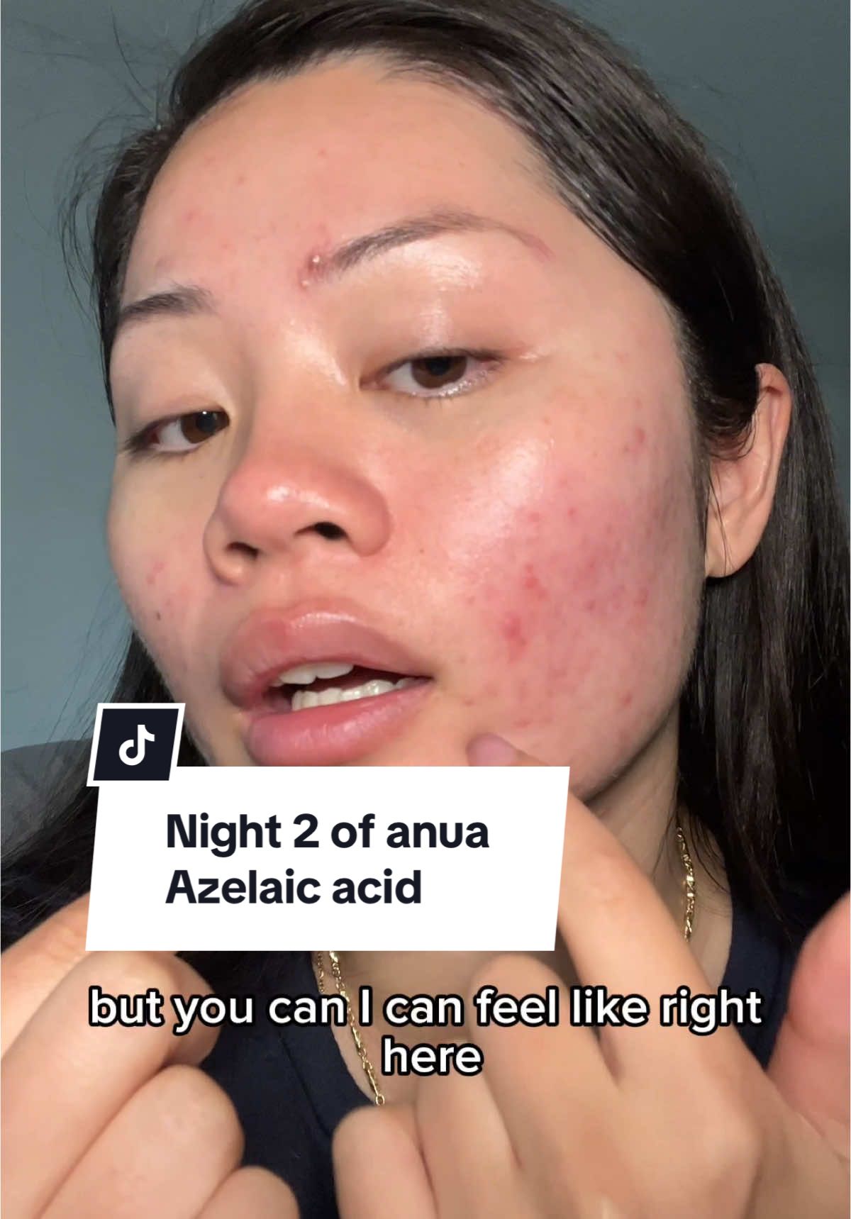 Night 2 update of using Anya Azelaic acid serum #acnetips #acne #acneskin #viralskincareproducts #kbeauty #acneproneskin #acnemarks #skincare #skintips #azelaicacid 
