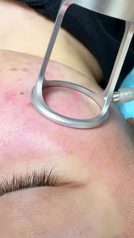 Ngày nào cũng xèo xèo, khi lazer nở rộ ra người người nhà nhà lazer. Nhưng để bền vững, lâu dài thì người chuyên môn vẫn hiệu quả, vẫn hot. Đây là phương pháp giảm mụn tốt, thu nhỏ lcl, sẹo đáy nhọn, tăng sinh tốt #lazerco2 #miaclinic