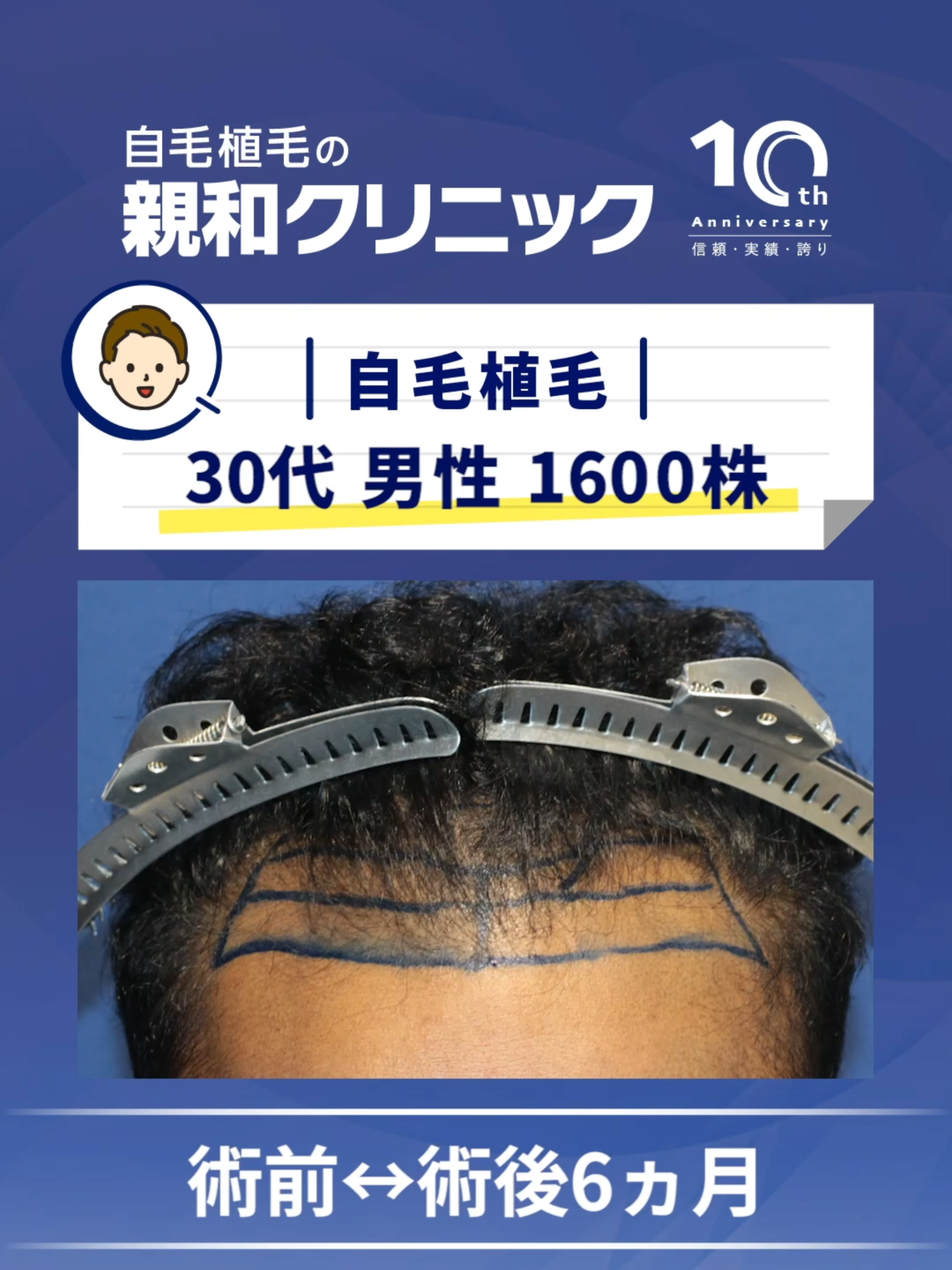 #AGA治療 #自毛植毛 #薄毛治療 #親和クリニック