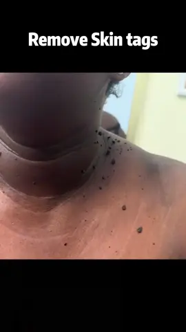Vanish Skin Tags and Scars, Rediscover Your Radiant Skin.#SkinTagRemoval #ScarAway #SkinRenewal #SkincareSolution #ScarTreatment #SkinTagEliminator #BeautifulSkin #SkinRestoration #FlawlessSkin