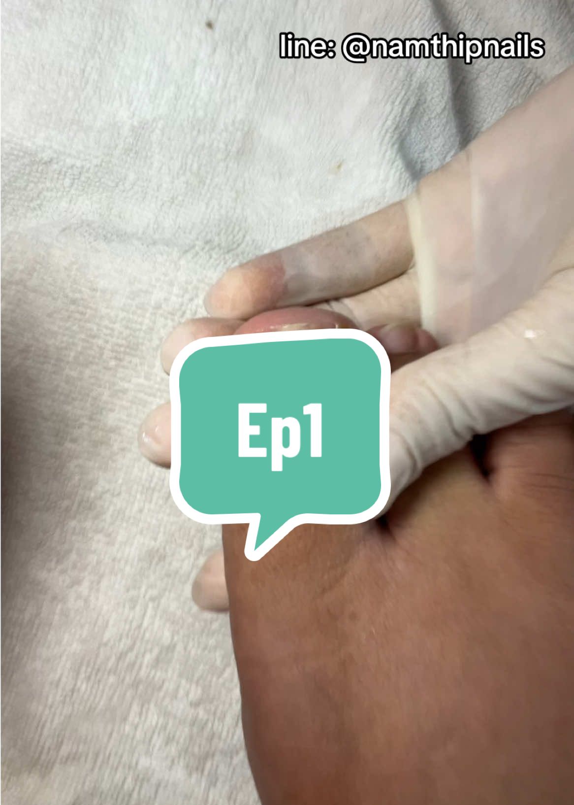 💓 #namthipnails #ตัดเล็บขบ #ตัดหนัง #ทำเล็บ #ร้านตัดเล็บขบ #ร้านตัดเล็บขบราม2 #ตัดเล็บ #เล็บขบ  #เล็บเชื้อรา Fb : namthipnails  Line : @namthipnails  นัมเบอร์วัน8 ตลาดม.ราม2  กทม  Map: namthipnails  https://goo.gl/maps/JmwpCKLfKwmhKGK96  ร้านเปิดทุกวัน เวลา12.00น-22.00น.