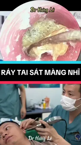 RÁY TAI SÁT MÀNG NHĨ #raytaisatmangnhi #layraytaicucphe #vesinhtaichuanykhoa #xuhuongtiktok #xuhuong2025 #