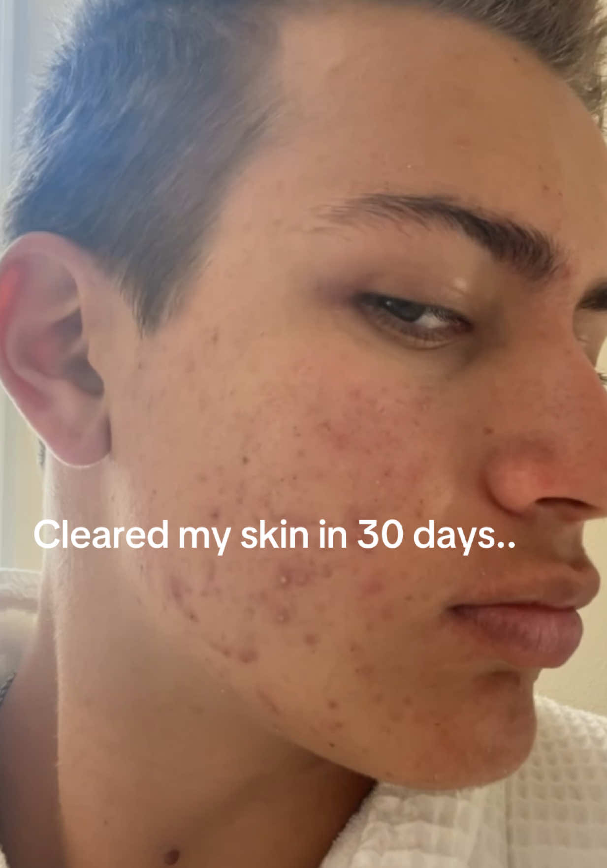 Cleared my skin by doing the opposite of what everyone told me. I tried every face wash, moisturizers.  Even the expensive sh*t behind the counter. It’d get better for a few days. Then come back worse. More redness. More breakouts. People kept telling me it was hormones. Stress. Sleep. That I needed another product. But none of it worked. And the more I tried to fix it, the worse it got. Until I stopped touching my skin and started looking at what was actually causing it. Not my genetics. Not bad luck. My gut. I cut the junk. No seed oils. No fake sweeteners. No processed food. Started eating real food beef, eggs, raw milk, fruit, etc. only used natural products. 30 days later, my skin was clear. No quick fixes. No routine. Just fixing the problem from the source. DM me “acne” and I’ll send you the exact food list I used.