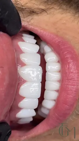 Onze klant uit Duitsland 🇩🇪. Op onze instagrampagina - hoogtepunt ‘Reviews’ deelt hij zijn ervaring met ons! Een stralende glimlach binnen 4 dagen 💎.  Benieuwd hoe wij ook uw glimlach kunnen transformeren?  Neem gerust contact met ons op voor een vrijblijvend advies.  📞 +31620438514 📪 Info@theglowmed.com 🔗 www.theglowmed.com #stralendelach #zirkoniumkronen #zirkonium #kronen #happysmile #teethtransformation #beforeandafter #smilemakeover #mooietanden #Tandheelkunde #Hollywoodsmile #smile #makeover #zirkoniumkronenturkije