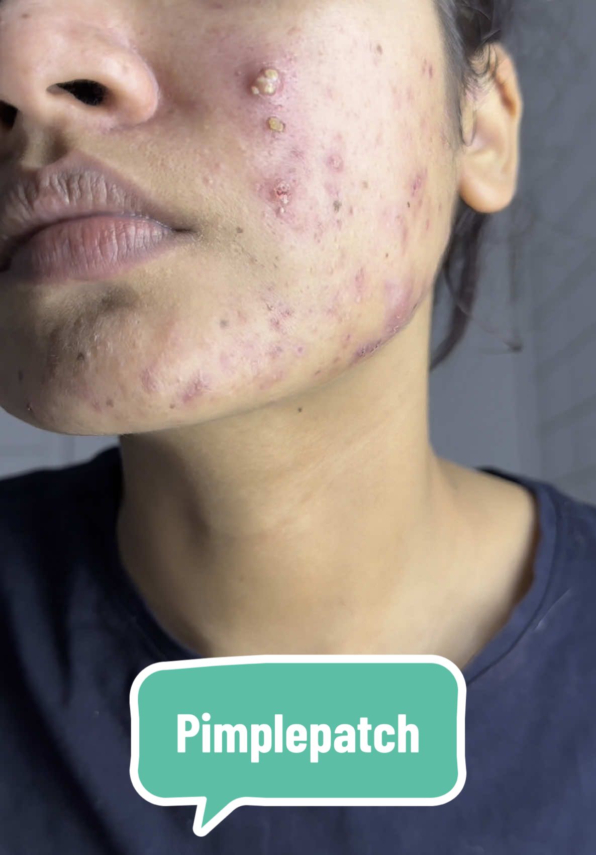 If you’re grossed out by this, congrats,you’ve clearly never dealt with real skin issues. This used to be my skin. Acne is normal. If I can heal, anyone can. This moment changed everything for me😊😊 #pimplepatch #acnecheck #skincarejourney #skintok #acnepositivity #realisticskincare #grossbutsatisfying #satisfyingskincare #acnepatch #pimplepatchremoval 