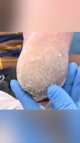 #callousedfeet #podiatry #callusremoval #callousremoval #parmeseanpalms #GroomingRoutine #foryoupage #reelsviralfb #podologia #callusedfeet #brazilianphonk #ゆー #ハート111 #skinpicking #calosidades #selfcaresundaytips #oddlysatisfying #dermatillomania 