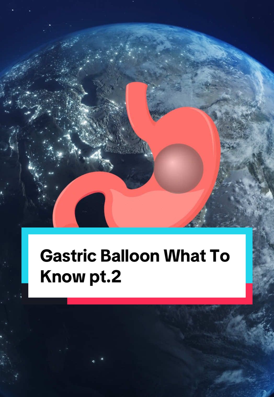 Gastric Balloon What To Know pt.2