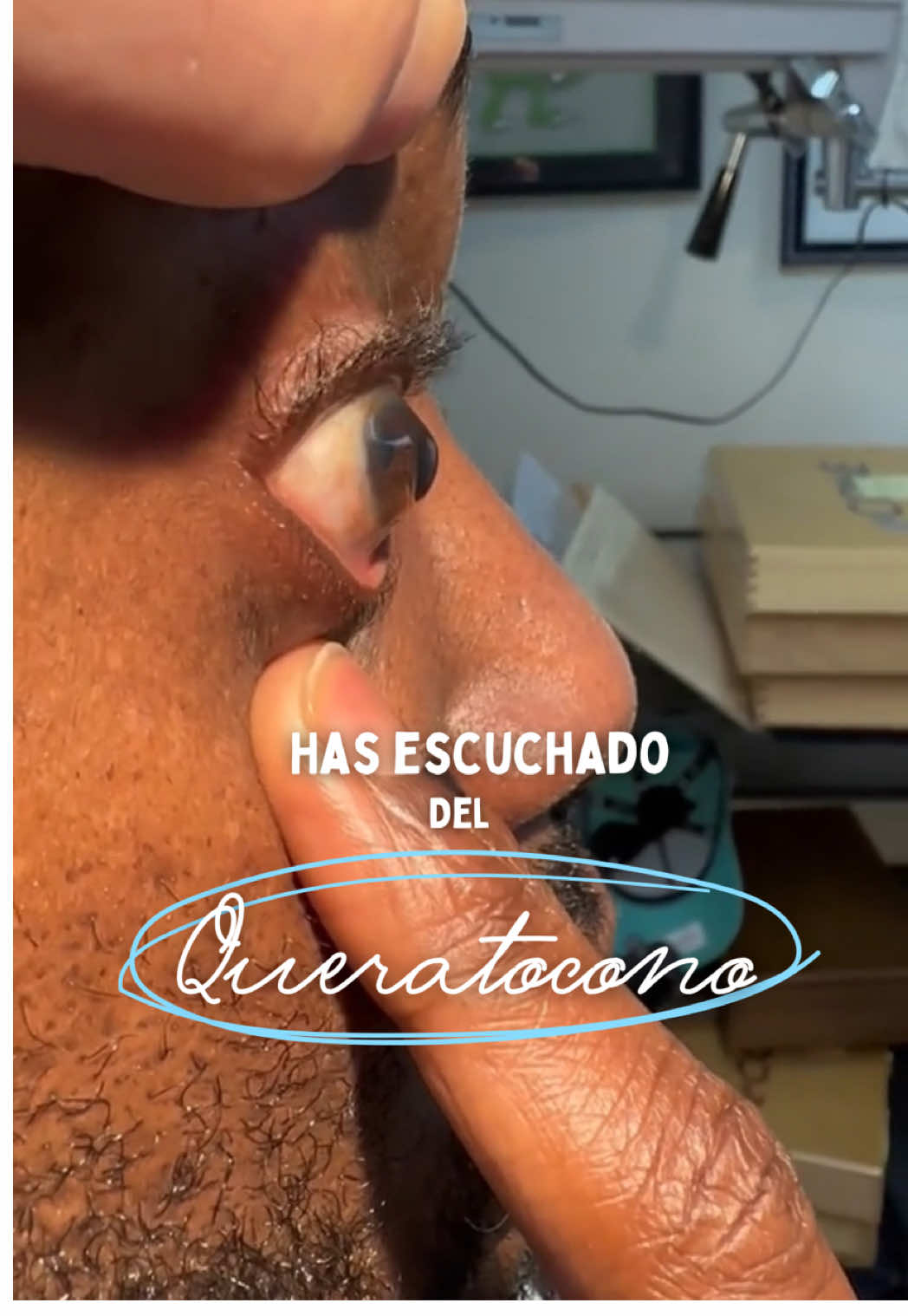 🟡 ¿Has escuchado del queratocono? Así se ve en etapa avanzada… 👁️‍🗨️ El queratocono es una enfermedad que deforma y adelgaza progresivamente la córnea, causando visión borrosa y distorsionada. ⚠️ En casos avanzados, como este, puede requerirse trasplante de córnea. ✅ Una revisión oftalmológica a tiempo puede evitar que avance. ❗Si tienes visión borrosa, cambios frecuentes de graduación o sensibilidad a la luz, ¡revísate! 👩🏻‍⚕️ Oftalmóloga Dra. Diana Parra  ✅ Oftalmólogo CERTIFICADO 🥇 ☎️ Directo 55 48 05 19 68  #Queratocono #SaludVisual #OftalmologíaCDMX #RevisiónVisual #Crosslinking #PrevenciónVisual #Córnea
