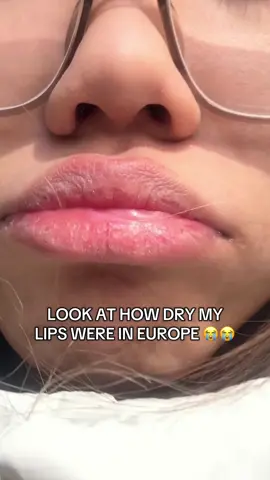 this was the most dry my lips ever got and thank god i had torriden to make it feel better 😭🤍 #torriden #torridenlipessence #lipessence #lipbalm #balm #drylips #tiktokshopsg #CreateToWin 