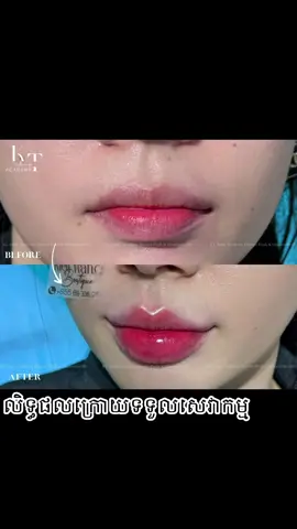 បបូរមាត់ក្រោយកែរួចពីខាងអូន 🫦 សាមញ្ញៗសម្រាប់បងប្អូនដែលស្រលាញ់បែបសុភាព 📆 ថ្ងៃទី 17 ខែ មិនថុនា អូនមានចុះទៅកំពង់សោមណា #shihanukville #cambodia🇰🇭 #fyp #trending #xuhuong 