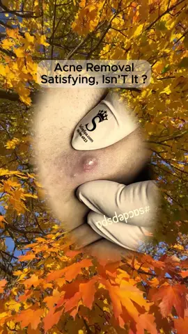 #squeezeyuk #satisfying #pimple #foryou #relax #fpy 
