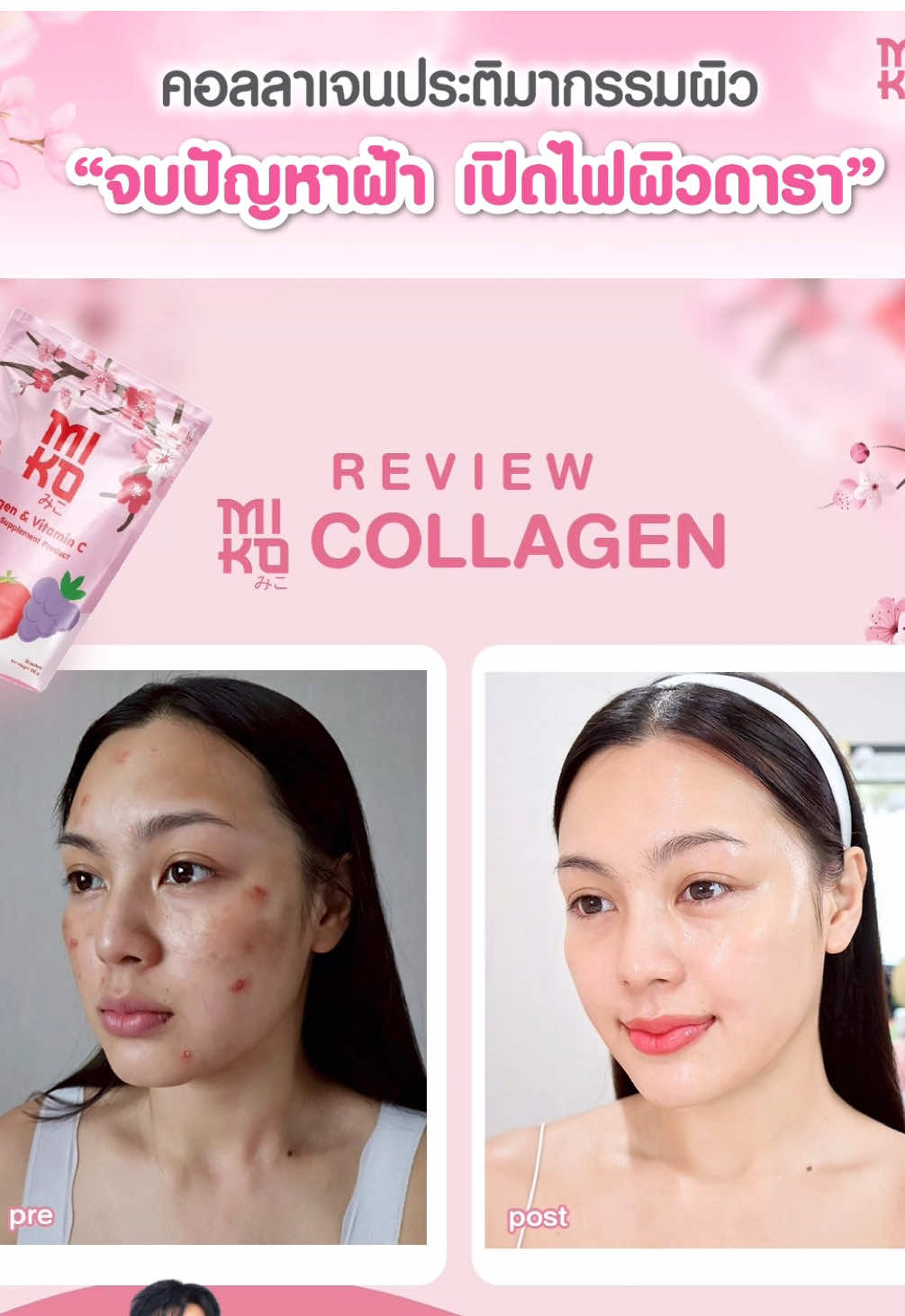 จบปัญหาผิว ด้วย Miko Collagen คอลลาเจนประติมากรรมผิว💓✨#mikocollagen #คอลลาเจนน้ําชา #คอลลาเจนเคลลี่ 
