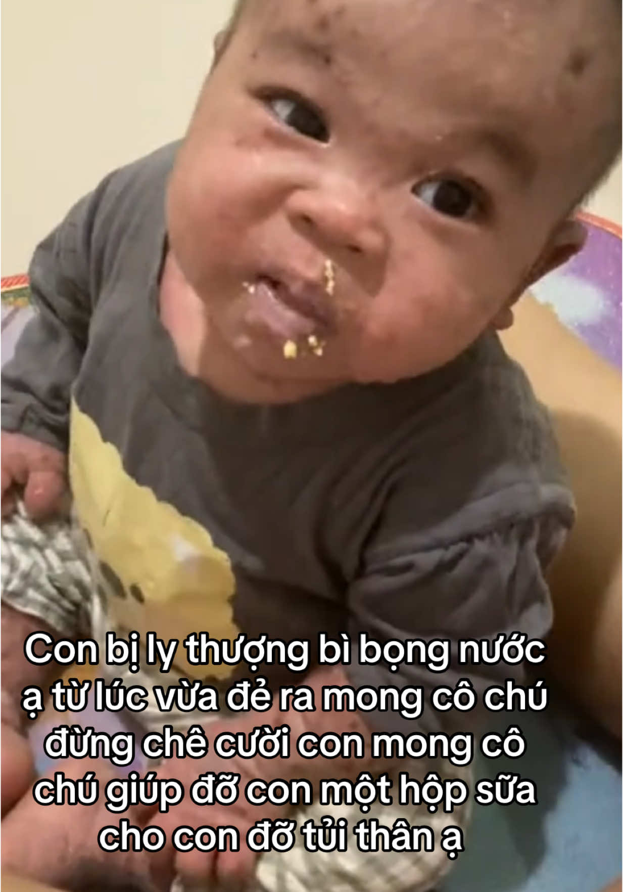 Con bị ly thượng bì bọng nước ạ từ lúc vừa đẻ ra mong cô chú đừng chê cười con mong cô chú giúp đỡ con một hộp sữa cho con đỡ tủi thân ạ #hoancanhkhokhan #xingiupdo 