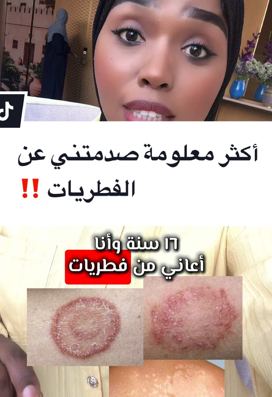أكثر معلومة صدمتني عن فطريات الجلد‼️ إذا صحتك تهمك كلمني على الرابط فالبايو عشان أساعدك ترجع تكون بخير🌱  @Fatma_albreiki  @Fatma_albreiki  @Fatma_albreiki  #فاطمة_البريكية #كوتش_فاطمة_إحساس_العافية‏ #Coach_fatma_albreiki  #جمال #مقاومة_الانسولين #اقوى_كويتيين #كانديدا #فطريات_الجلد #الفطريات #عادة #صحيه #علاج_طبيعي#فطريات_جلدية #معاناة #تجربتي #تشافي  #Fatma_albreiki #برنامج_الصحة_المستدامة #صحة_الجلد  #تثقيف_صحي #فطريات #فطريات_جلدية  #صحة_تغذية  #عدوى #مناعة #علاج_الفطريات  #الصحة_المستدامة 