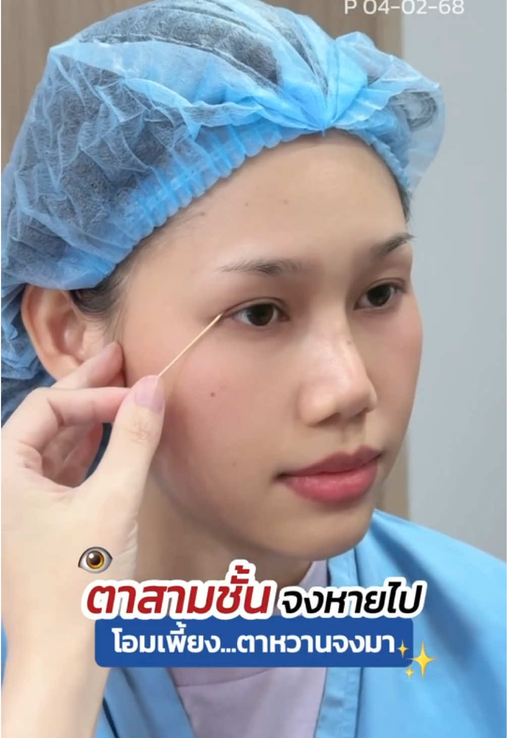 ปัญหาตาสามชั้นแบบนี้ แก้ยังไงดี😞 #รีวิวทำตาสองชั้น #skyclinic #จักษุแพทย์ #หมอสกาย #ทำตาที่ไหนดี #สกายคลินิก #ศัลยกรรมตา 