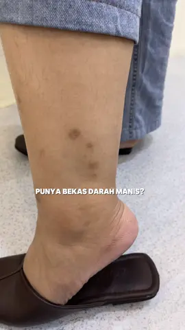 bekasnya udah memudar banget🤩 dirutinin pake si gentong ini🧏🏻‍♀️🥰