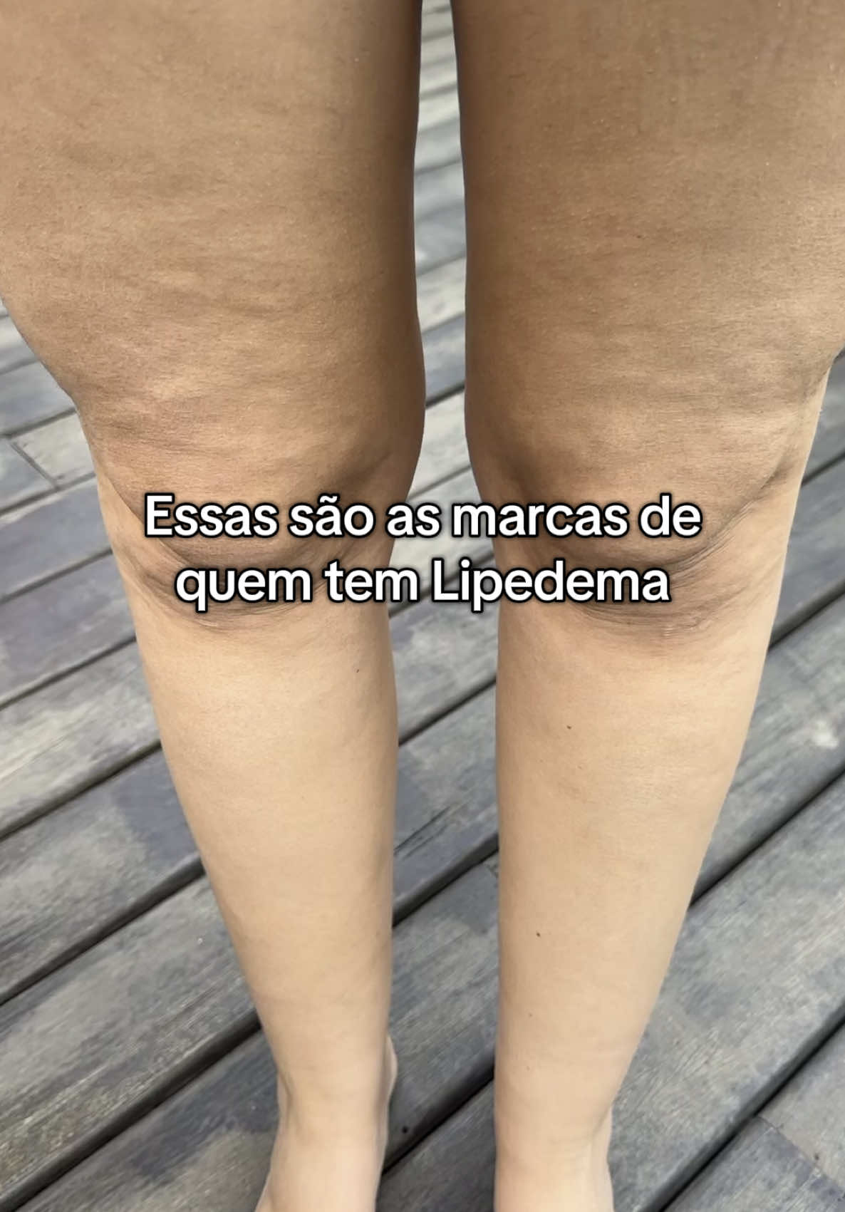 Quem se identifica comenta aqui 😢 #lipedema #mulheres #fyp #celulites #inchaço 