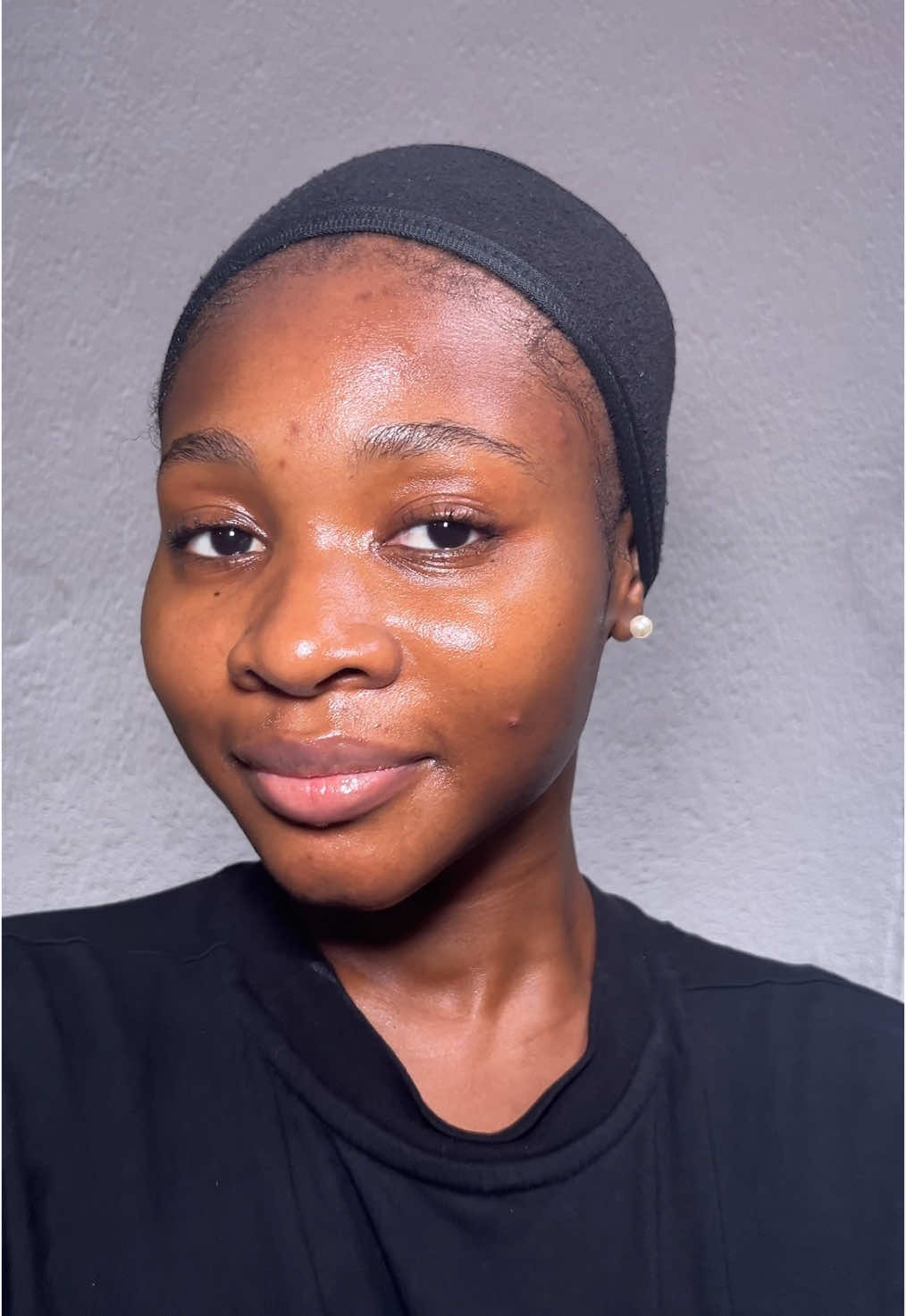 Part 3| Byeeeee Acne  #skincare #acnetreatment #clearskin #fyp #kbeauty 