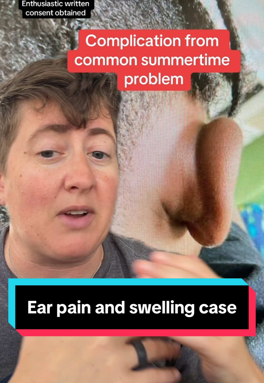 This is a complication of swimmer’s ear or otitis externa! We see a lot of swimmers ear cases over the summer, because ear canals are warm, wet and dark. It can be REALLY painful! We usually treat with drops, but if things aren’t getting better, we need to do more to investigate! #earpain #case  #infection #emergency #ent  Disclaimer: For educational and entertainment purposes only and should not be regarded as medical advice or replace the advice of your physician