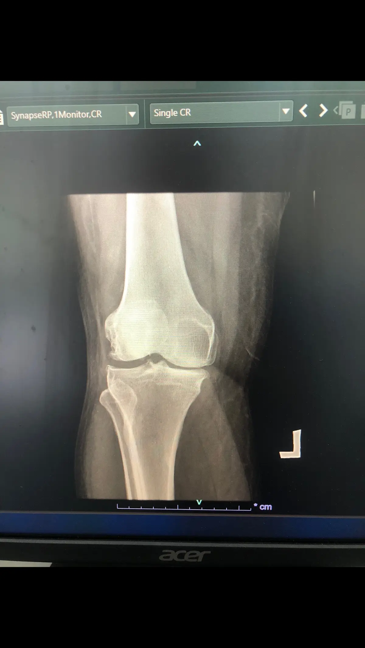 Gambar x ray pesakit yang ada osteoarthritis (radang sendi) lutut kanan. Rawatan fisio: 1.ice/hotpack untuk mengurangkan sakit dan bengkak 2.senaman regangan dan kuatkan otot,maintainkan pergerakkan sendi lutut 3.gait training 4.patient education #physiotherapy #osteorartritis 
