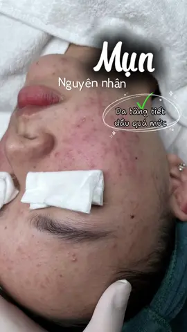 Mấy Ní da mụn tham khảo nhé! Hiểu rõ nguyên nhân và bắt đầu điều trị mới đạt hiệu quả tối đa…🍀 #emdepspadanang #spaduocmypham #spachamsocdachuyennghiep #mụn #chamsocda 