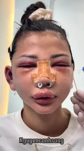 Sưng bầm là bình thường nha mn #muitrunghoa #nangmuidep #xuhuong #hidung #thammy #muigo 