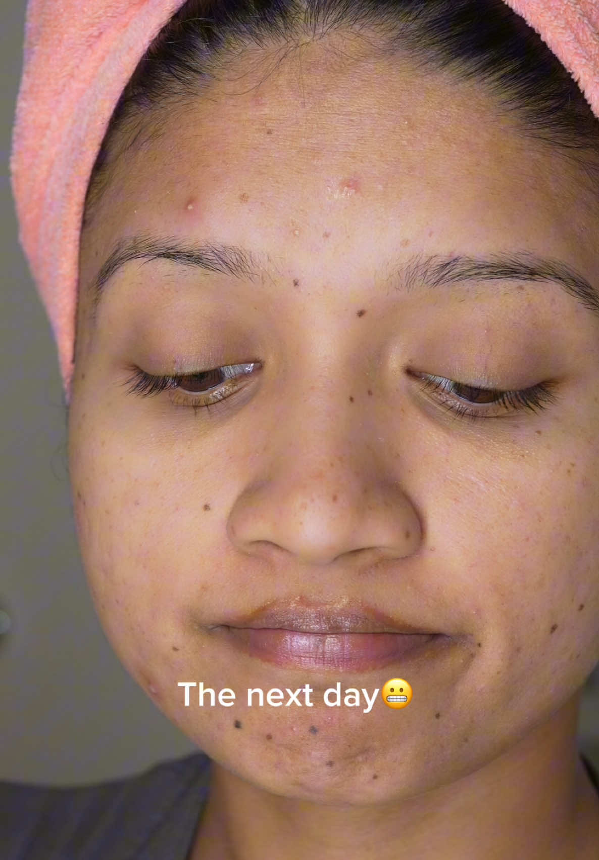 Uninvited guest🫩🫩 Saw this from @dan_lifestyle1 and had to do my version😂  #cysticacne #acne #acneskin 