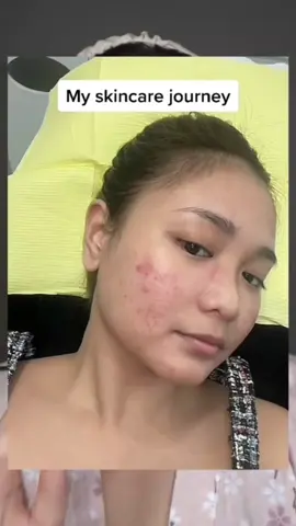 @lousanchezzzzz' clear skin journey with Oxecure. Join the clear skin club — get it now on our Tiktok Shop!