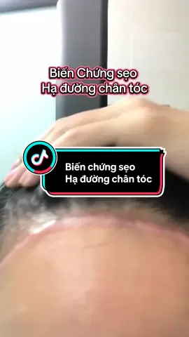 🌏 Biến chứng thẩm mỹ. Hạ đường chân tóc #haduongchantoc #TriSeoRo #triseothunhantrung #triseoloi #XuanNguyen_ColdPlasma #LặngLẽTáiSinh #ChuyểnGiaoCôngNghệSpa #hanhtrinhlangletaisinh #kemtriseosauphauthuat #triseosauphauthuat #ColdPlasmaChuanHan 