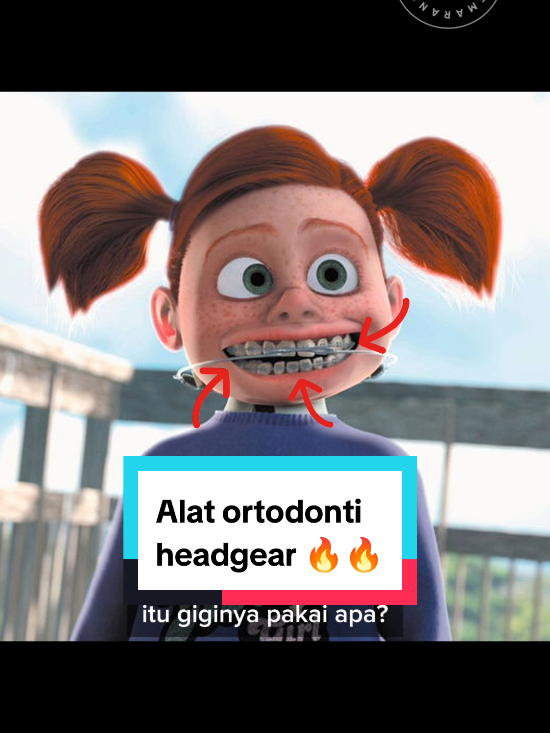 ada yang pernah atau lagi pakai alat headgear ini? #doktergigisemarang #nemo #headgear