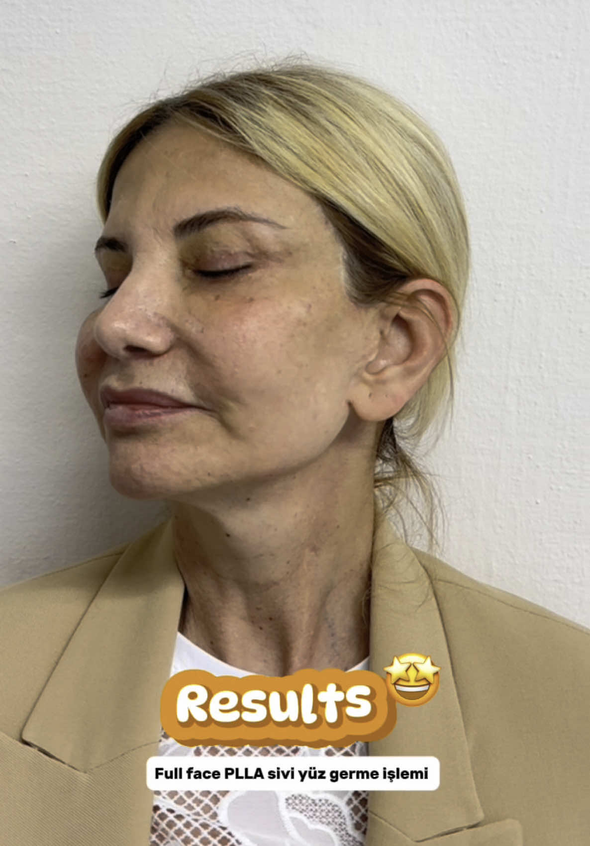 💧 What is PLLA Liquid Face Lift? The PLLA (Poly-L-Lactic Acid) Liquid Face Lift is a non-surgical facial rejuvenation treatment designed to restore lost volume and improve skin firmness by stimulating your body’s natural collagen production. 🌟 Key Benefits 	•	✔️ Stimulates natural collagen synthesis 	•	✔️ Improves skin texture, elasticity, and volume 	•	✔️ Long-lasting results (up to 18–24 months) 	•	✔️ Minimally invasive with little to no downtime 	•	✔️ Effective for cheeks, temples, jawline, and overall facial contour Please leave your message down below or DM directly for your own consultation 📲☎️ #liquid #facelift #polylacticacid #aesthetic#keşfetteyizzz #keşfet 