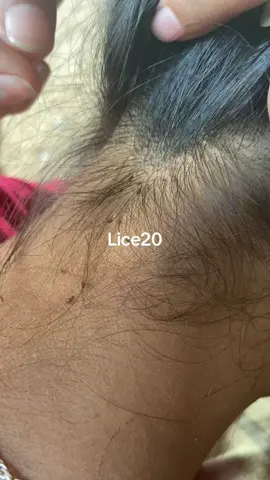 😱😱#omg #lice #liceremoval 