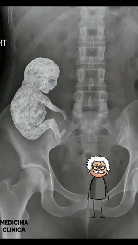 hijo que nunca nació… pero nunca se fue La historia de Rosa y su bebé calcificado Rosa tenía 74 años cuando llegó al hospital. Dolores abdominales crónicos, sensación de masa en el vientre y una historia clínica escasa. Vivía en una zona rural, sin acceso regular a atención médica, y durante décadas había aprendido a vivir con molestias que consideraba “parte de la edad”. Pero esta vez era diferente. Un ultrasonido reveló algo inusual. Una masa dura, calcificada, con forma claramente reconocible. El equipo médico ordenó una tomografía. Y entonces apareció: un feto petrificado. Un bebé que jamás nació… pero que había estado con ella por más de 30 años. Rosa no se sorprendió. Solo bajó la mirada y murmuró: “Yo sabía que algo quedó dentro de mí.” Contó que, a sus 40 años, sintió los síntomas de un embarazo: náuseas, movimientos, hinchazón. Pero vivía lejos de todo, sin ecografías ni médicos. Un día, el movimiento cesó. Y con el tiempo, los síntomas desaparecieron. No hubo sangrado, ni parto, ni explicación. Solo un vacío… y una extraña masa en su abdomen que fue creciendo sin hacer ruido. Lo que tenía Rosa se llama litopedion, o niño de piedra. Una condición extremadamente rara en la que un embarazo ectópico abdominal, al morir y no poder ser reabsorbido por el cuerpo, se calcifica como un mecanismo de defensa. El organismo “encierra” al feto en una capa de calcio para evitar una infección o una respuesta inmunológica. Puede permanecer ahí décadas… sin que nadie lo sepa. En cirugía, extrajeron cuidadosamente los restos calcificados. El esqueleto aún conservaba parte de su forma original: costillas, cráneo, una pequeña mano. Los médicos estaban impactados. Rosa no. Para ella, no era un hallazgo clínico. Era su hijo. El que nunca lloró. El que nunca vio nacer. Pero que siempre estuvo con ella. Hoy, su historia no solo asombra a los médicos. Nos recuerda que el cuerpo guarda memorias que la mente a veces entierra. Y que detrás de cada diagnóstico raro… hay una vida, un dolor y un amor que nunca se dijo en voz alta.#viral #parati #curiosidades #noticias 
