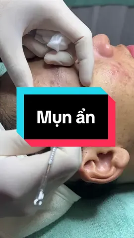 Mụn ẩn#winspavungtau #trimunvungtau #nanmunvungtau #nanmun #spauytinvungtau 