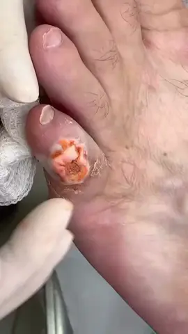 #tumor #fy #satisfacaogarantida #unhaencravada 